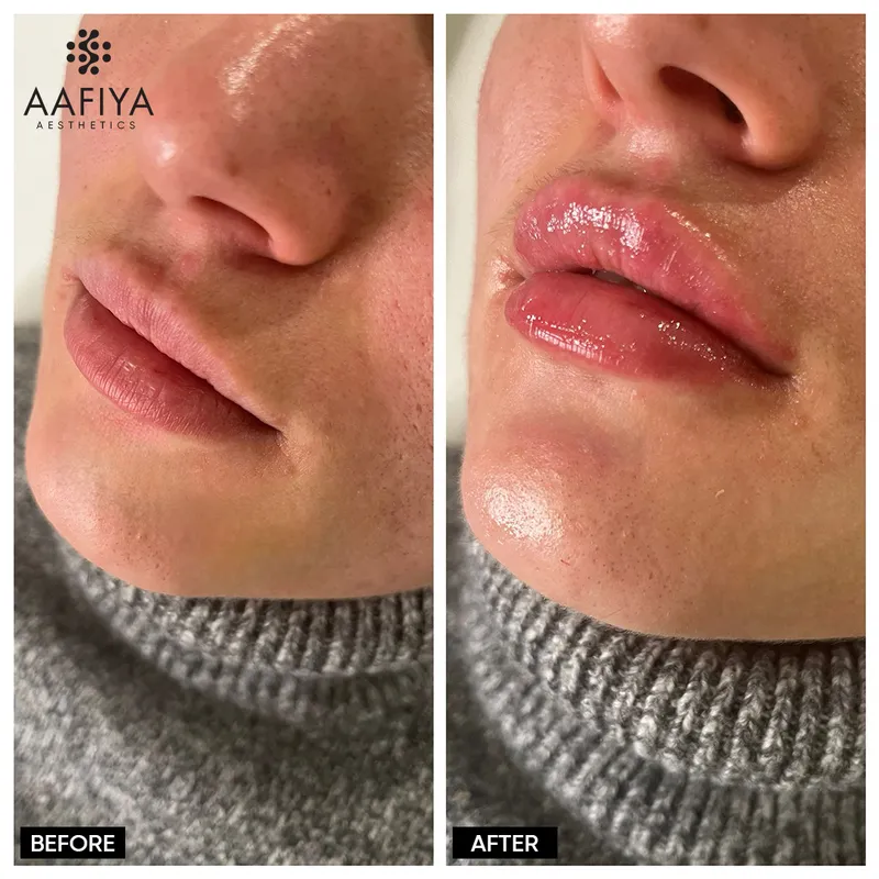 lip-fillers-nottingham